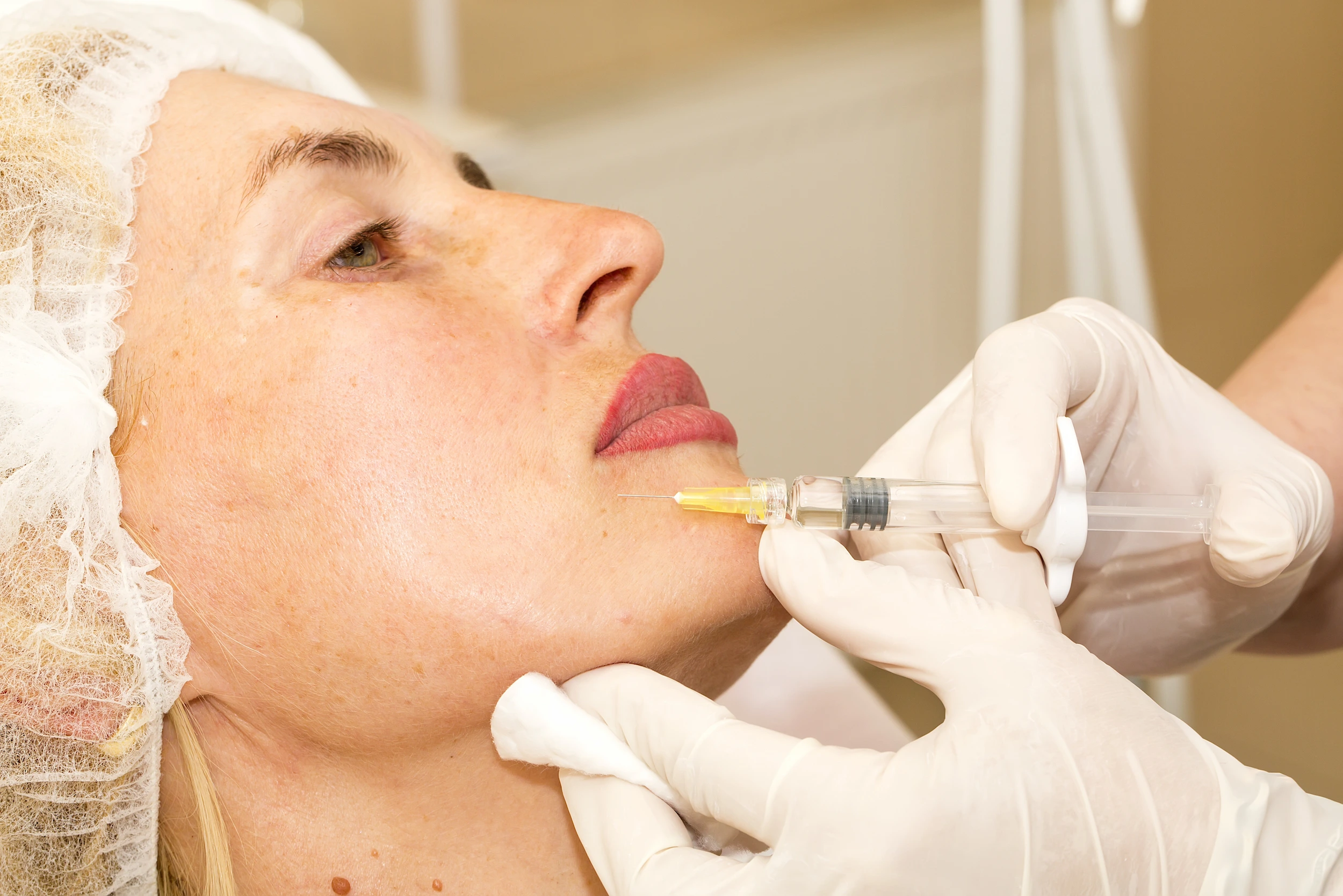Une personne coiffée reçoit une injection cosmétique au niveau du menton de la part d'un professionnel médical ganté, qui tient une seringue et un tampon de coton contre la peau du patient.